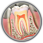 Root Canal Treatment Mt. Sinai